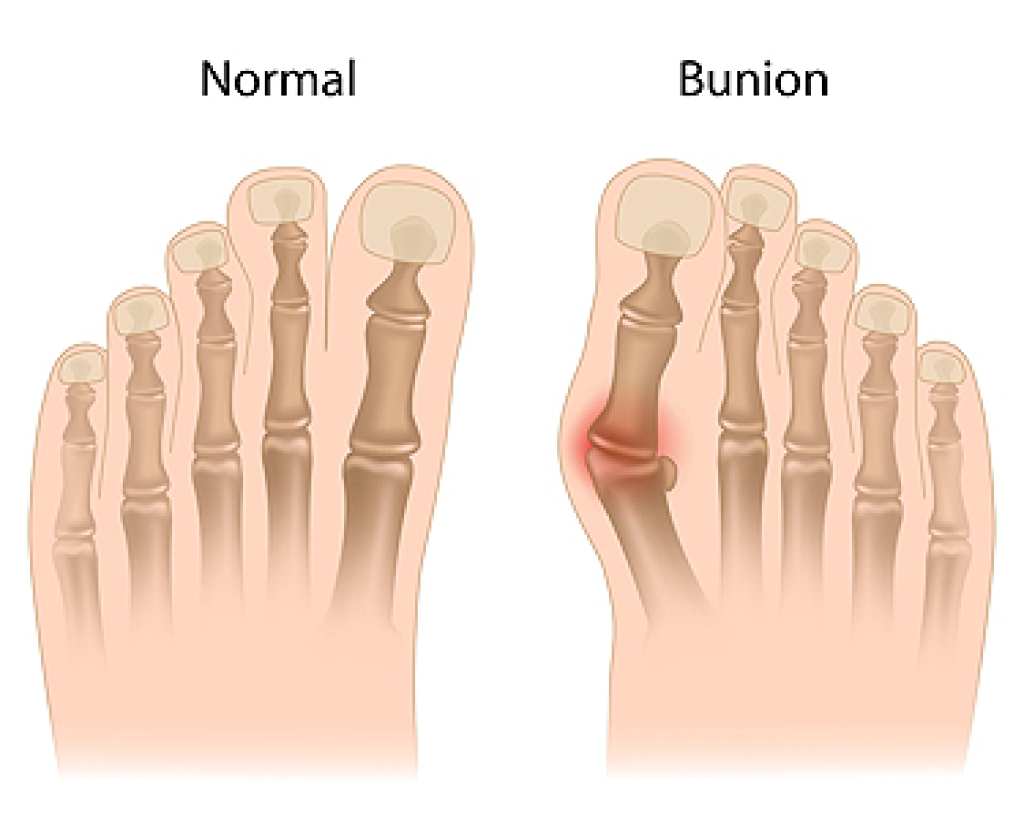 Risk Factors for Bunions