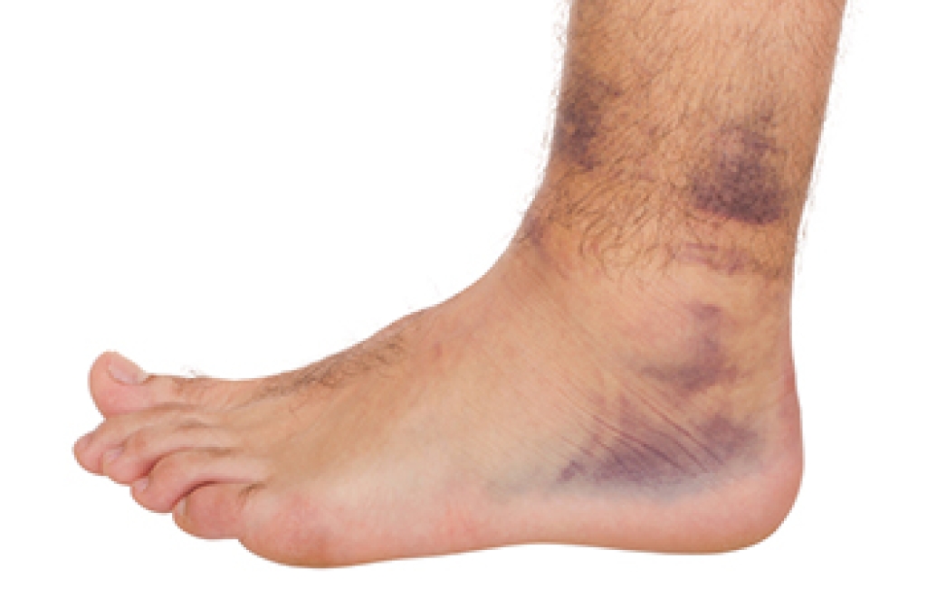 Symptoms of Ankle Sprains