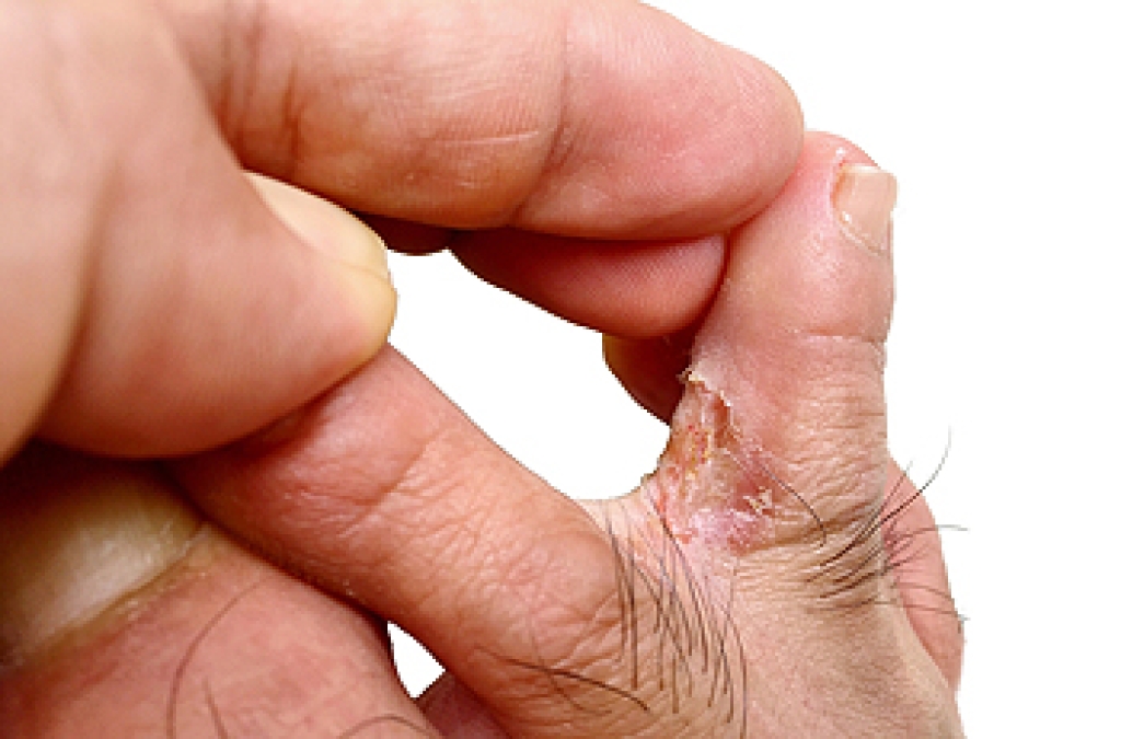 Definition and Risk Factors for Athlete’s Foot