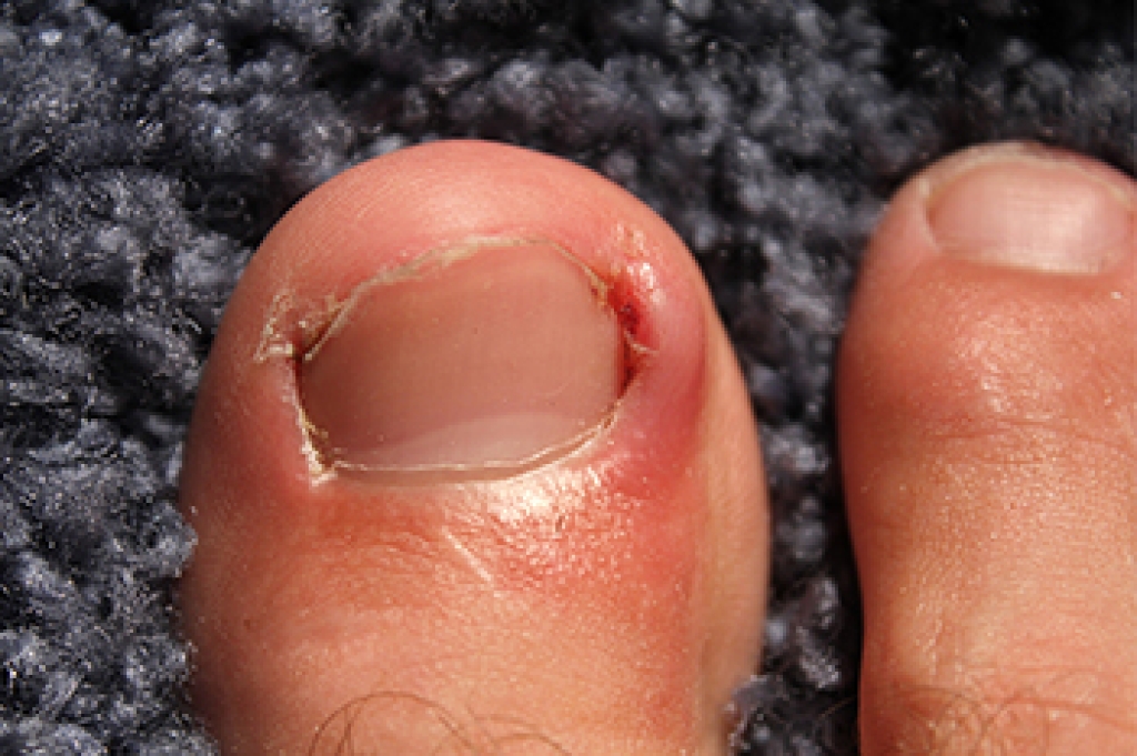 Why Ingrown Toenails Become Painful