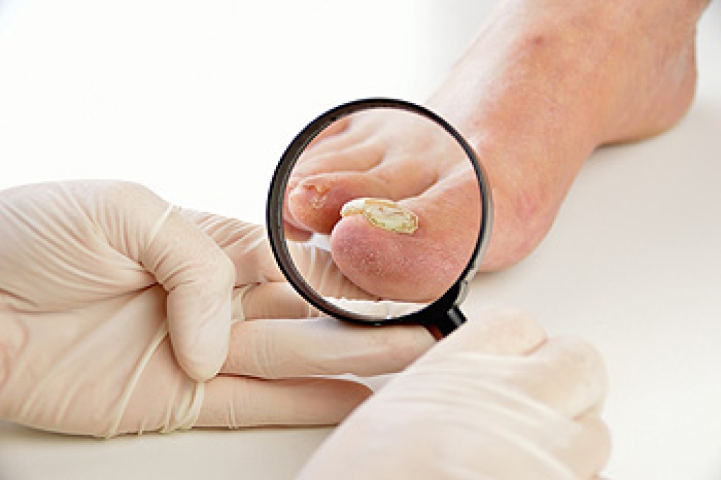 What Are the Symptoms of Toenail Fungus?