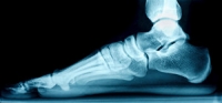 Causes of Flat Feet