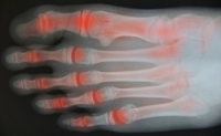 Toe Arthritis May Be Common